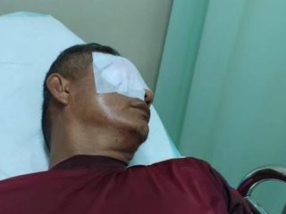 Seorang guru di SMAN 7 Rejang Lebong, Bengkulu, Zuharman (58) mengalami luka parah usai matanya diketapel oleh orang tua murid bernama Arpanjaya(45).