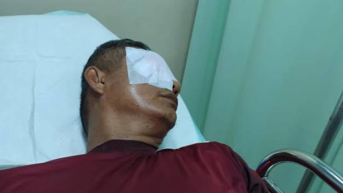 Seorang guru di SMAN 7 Rejang Lebong, Bengkulu, Zuharman (58) mengalami luka parah usai matanya diketapel oleh orang tua murid bernama Arpanjaya(45).