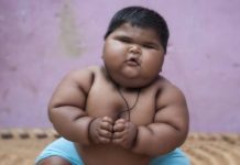 Pakar kesehatan anak dari Ikatan Dokter Anak Indonesia (IDAI) Banten dr Novitria Dwinanda, Sp.A. Subsp.N.P.M mengatakan anak dengan obesitas tak hanya ditandai pipi tembam, tetapi juga leher yang hitam dan ini tak bisa dihilangkan.