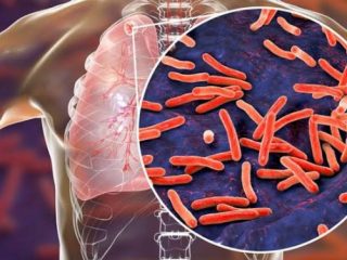 Indonesia saat ini berada pada urutan kedua jumlah kasus tuberkulosis (TBC) di dunia dengan estimasi 969.000 kasus.