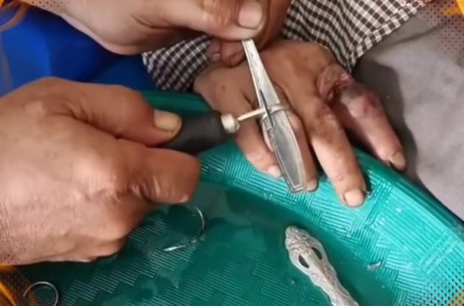 Tim Damkarmat Kota Medan berhasil melepaskan sejumlah cincin di jari seorang pria yang sudah melekat dan susah dilepaskan
